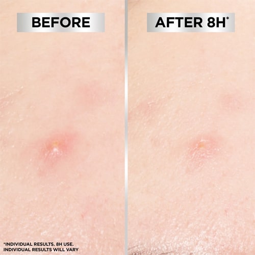 پچ ضد جوش نوتروژینا Neutrogena بسته 24 تايى